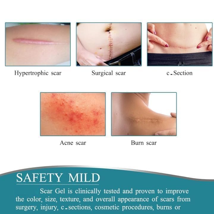 Silicone Scar Sheets,Silicone Scar Tape,Scar Tape For Surgical Scars,Silicone Scar Removal Strips For Surgical,C-Section,Tummy Tuck,Keloid Scars,Acne Scars, Reusable (1.6