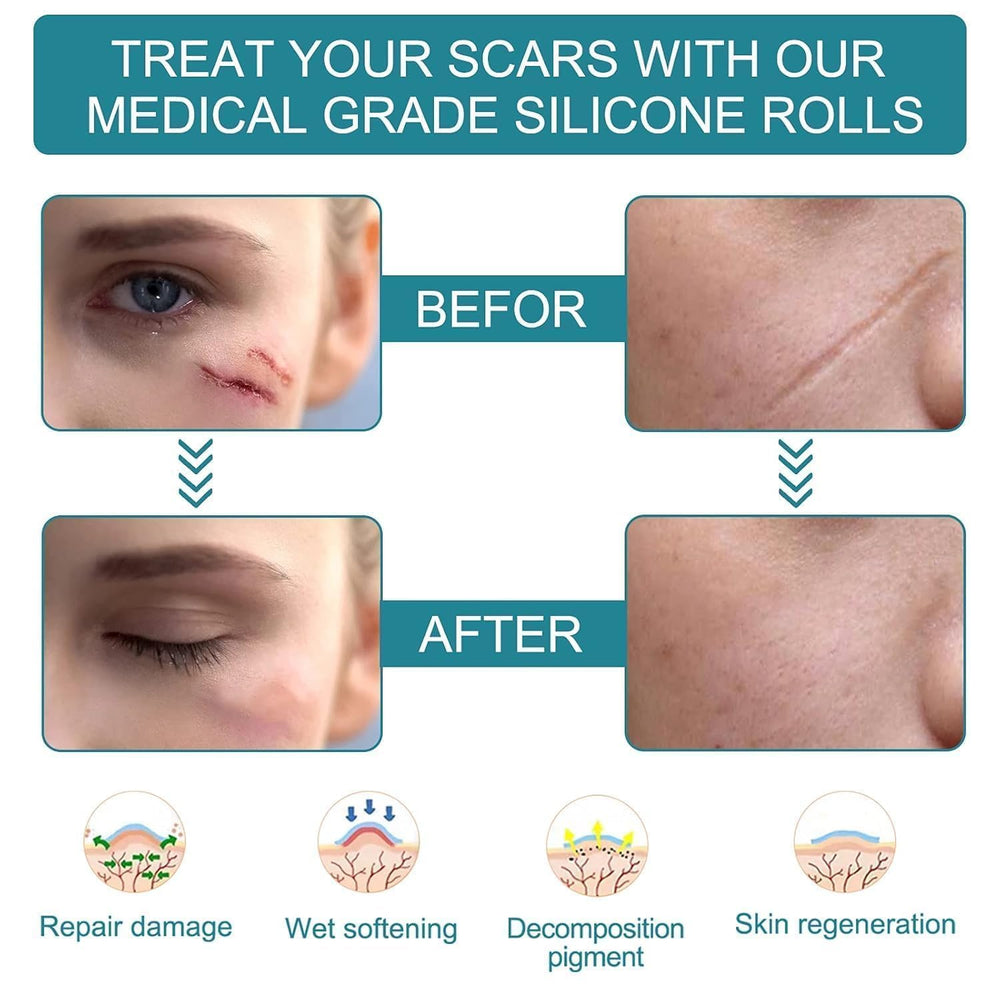 Silicone Scar Sheets,Silicone Scar Tape,Scar Tape For Surgical Scars,Silicone Scar Removal Strips For Surgical,C-Section,Tummy Tuck,Keloid Scars,Acne Scars, Reusable (1.6
